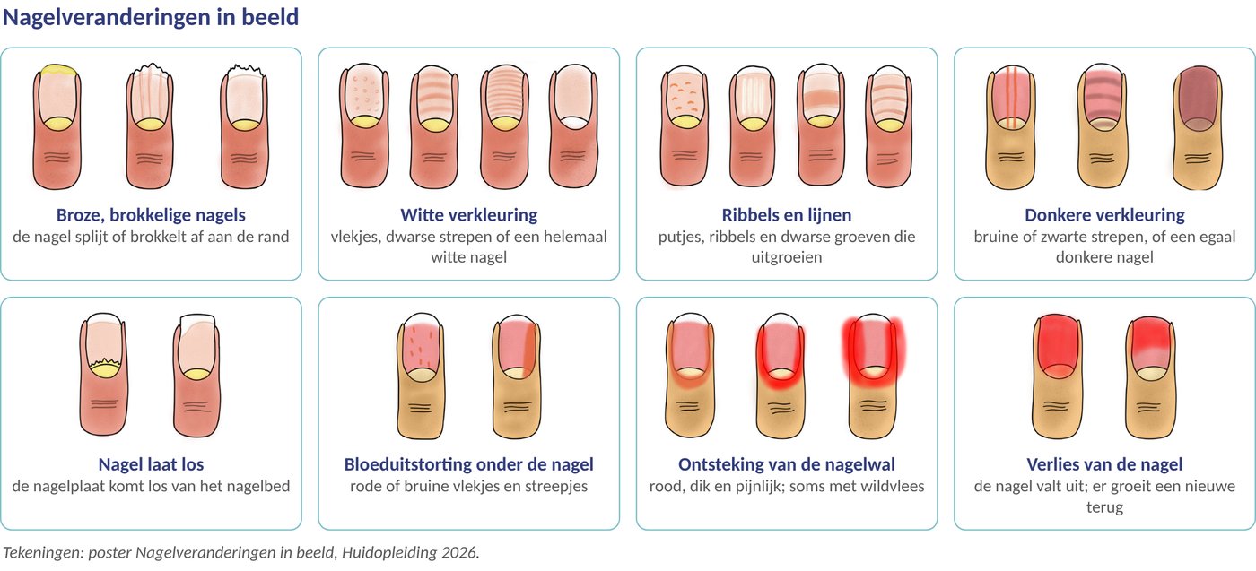 De nagelveranderingen